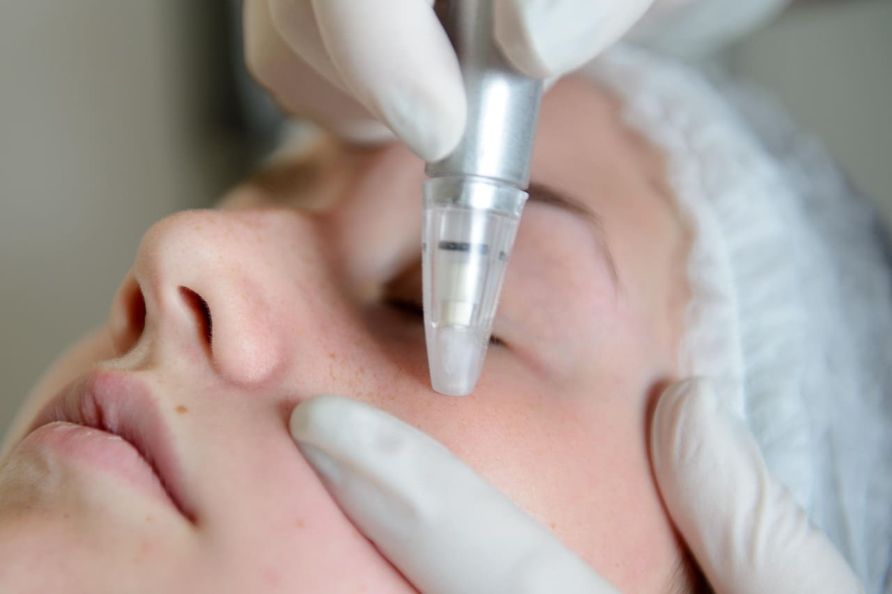 RADIOFRECUENCIA FACIAL